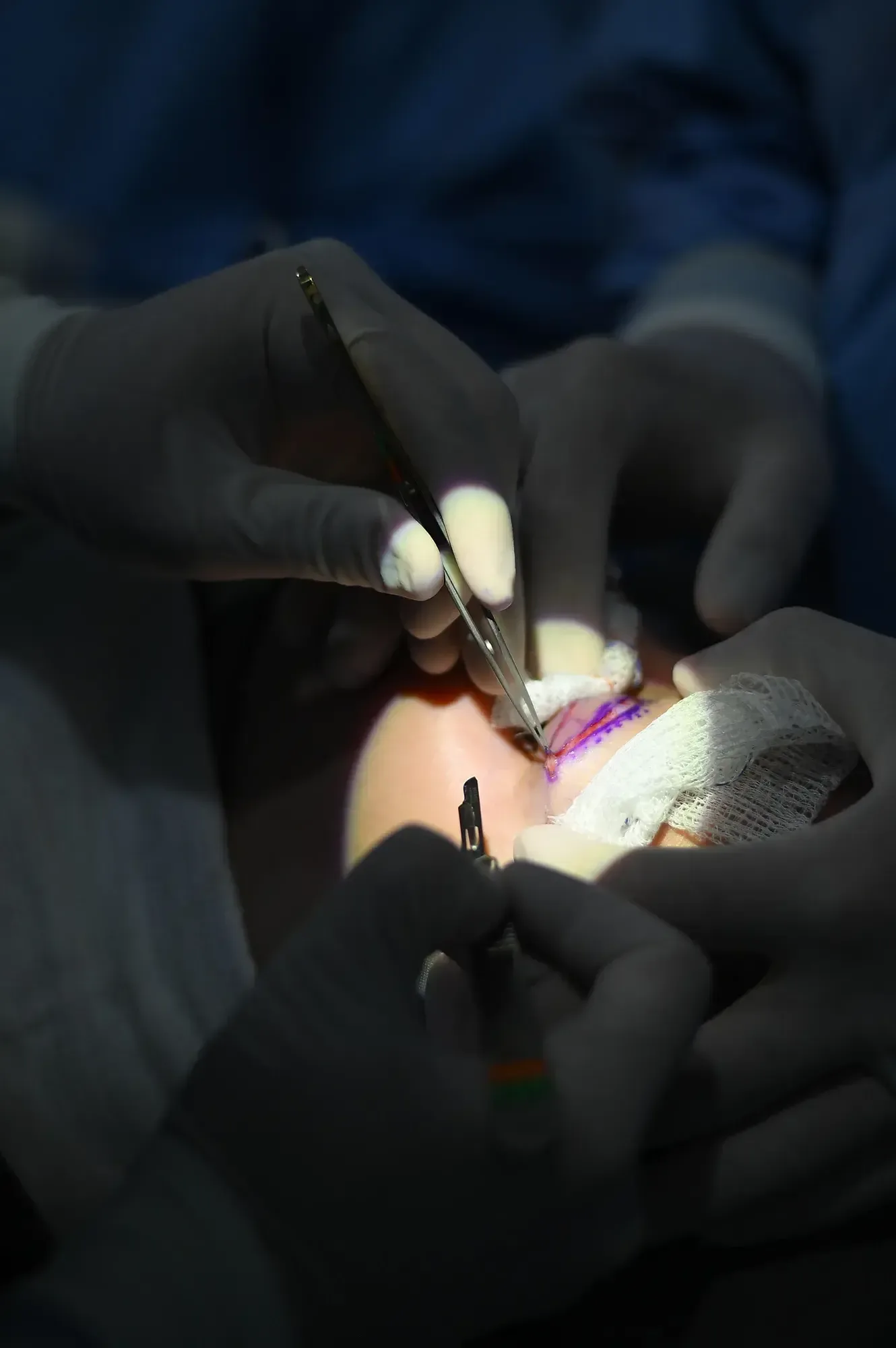 Blefaroplastia — procedimento